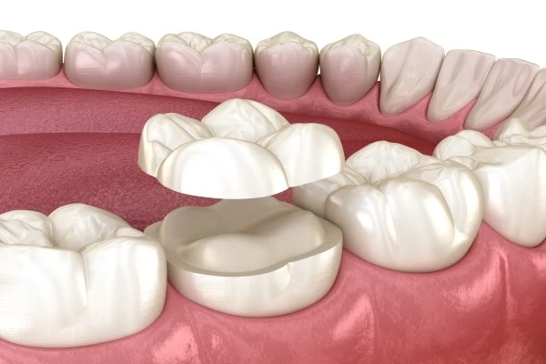 Dental Crowns Homewood AL - What Are Dental Crowns?