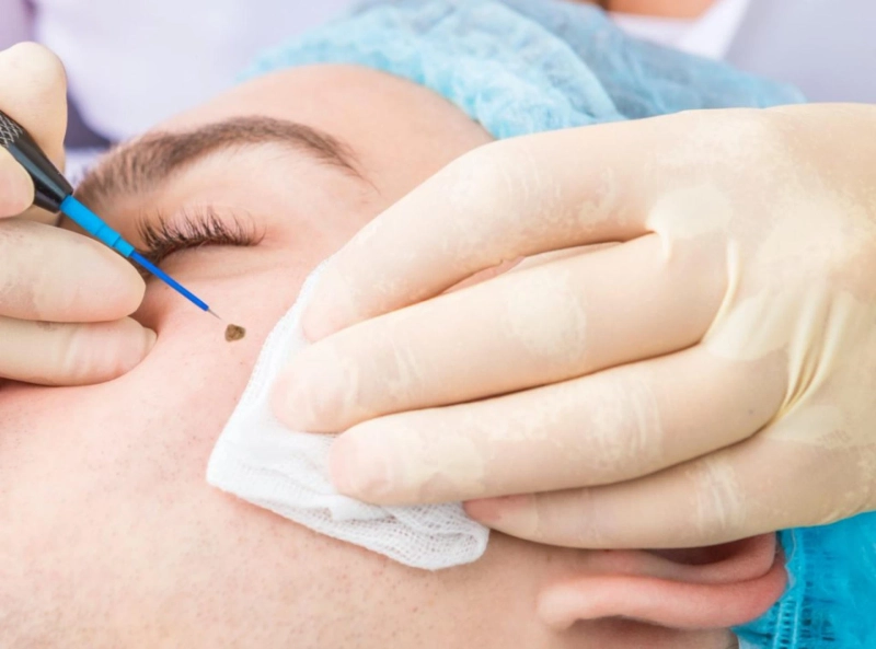 Understanding the Healing Process: Laser Mole Removal Recovery