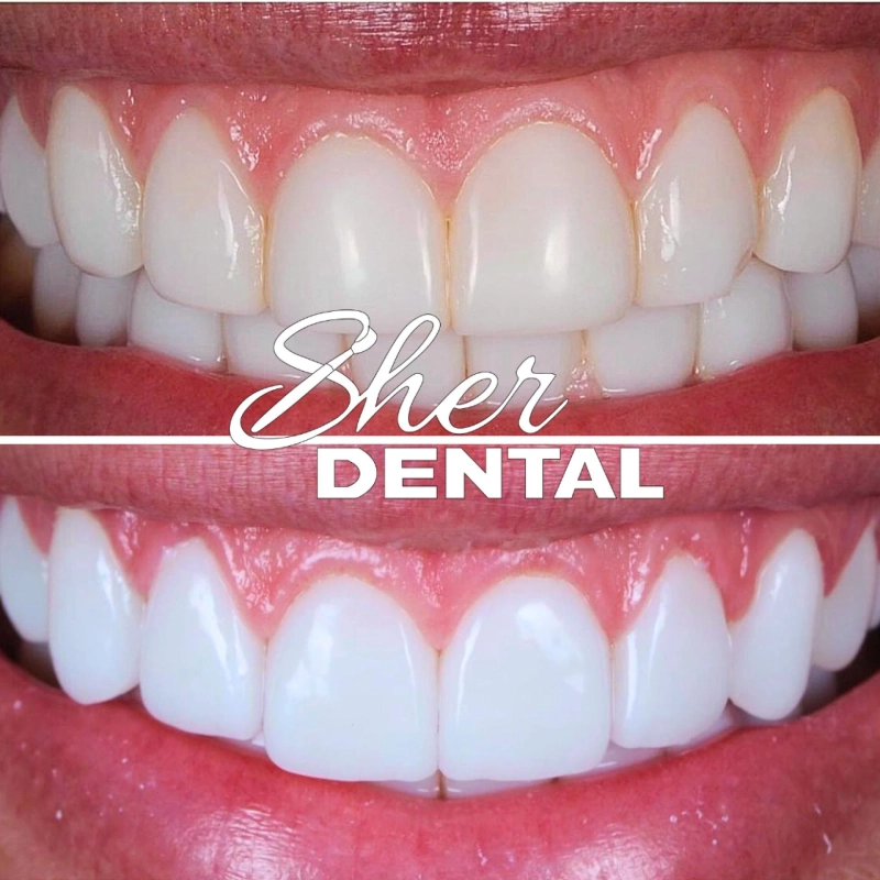 What Veneers Can Fix: Chips, Gaps, Discoloration, and Uneven Teeth