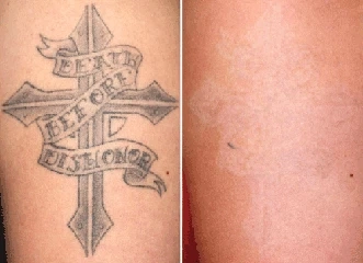 Tattoo removal New York services using laser technology