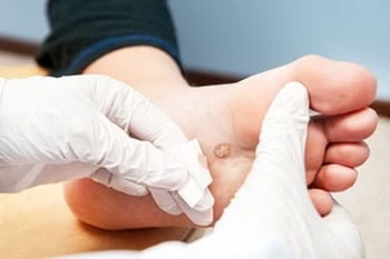 The Most Effective Treatment for Plantar Warts