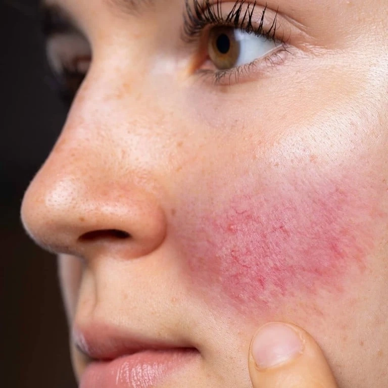 Dermatologist-Approved Rosacea Treatments in Dubai