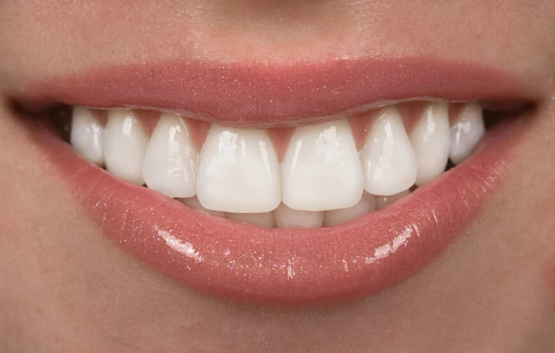 How much does a full set of veneers cost?