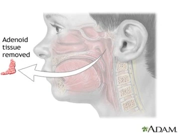 Adenoid Surgery Cost and Effective Adenoids Treatment: What You Need to Know