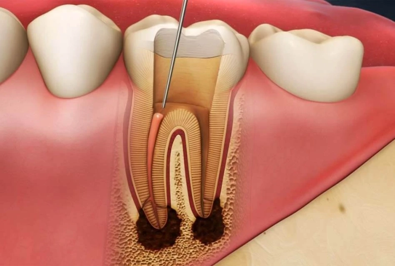 Decoding the Myths and Realities of Root Canal Treatment: A Comprehensive Guide