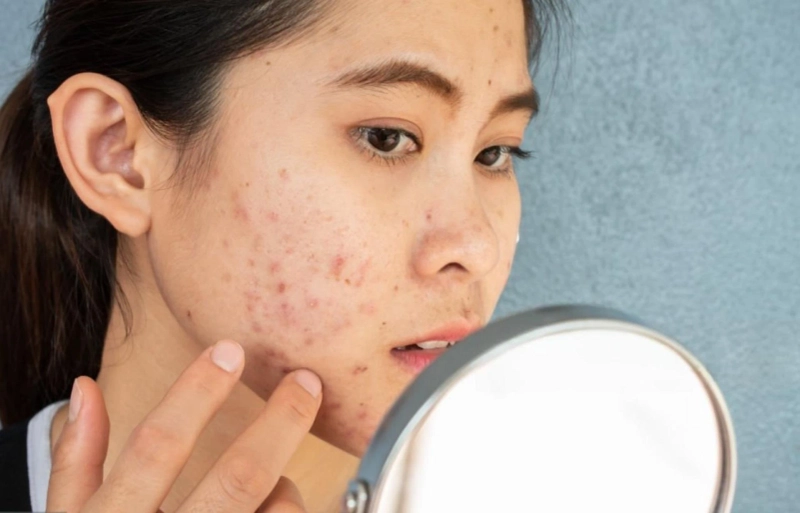Rosacea vs. Eczema: How to Tell the Difference and Soothe Your Skin