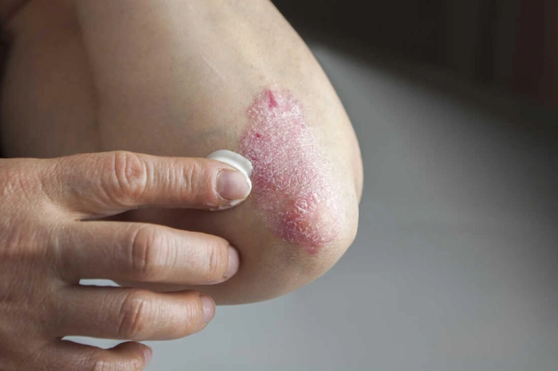 Sun, Sand, and Skin: Managing Dermatological Issues in Dubai