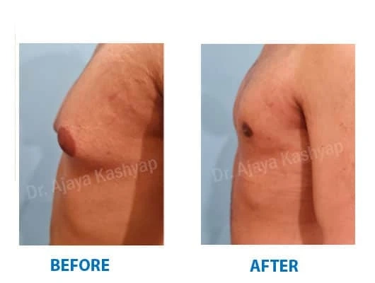Gynecomastia - Men with Enlargement of Breasts