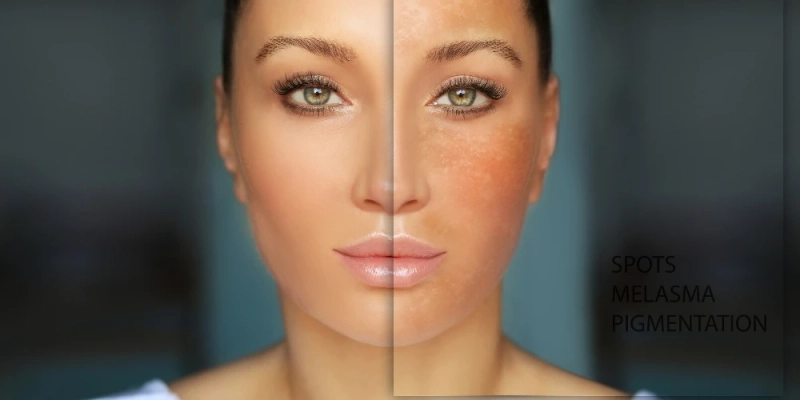 Fast and Effective Melasma Treatment Methods for Visible Results