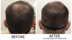 Advanced Hair Regrowth Without Surgery: Exosome Therapy in Peshawar