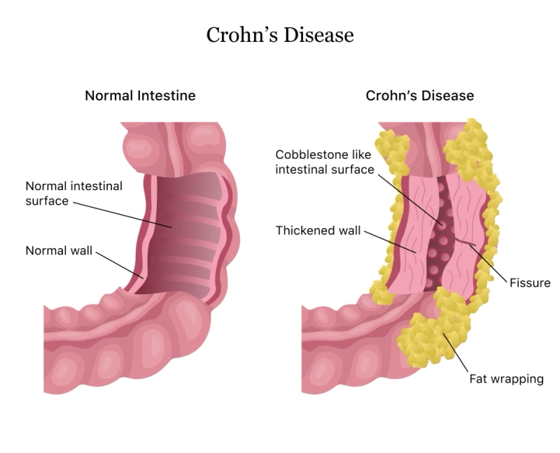 CBD for Crohn's Disease: Understanding the Potential Benefits and Usage