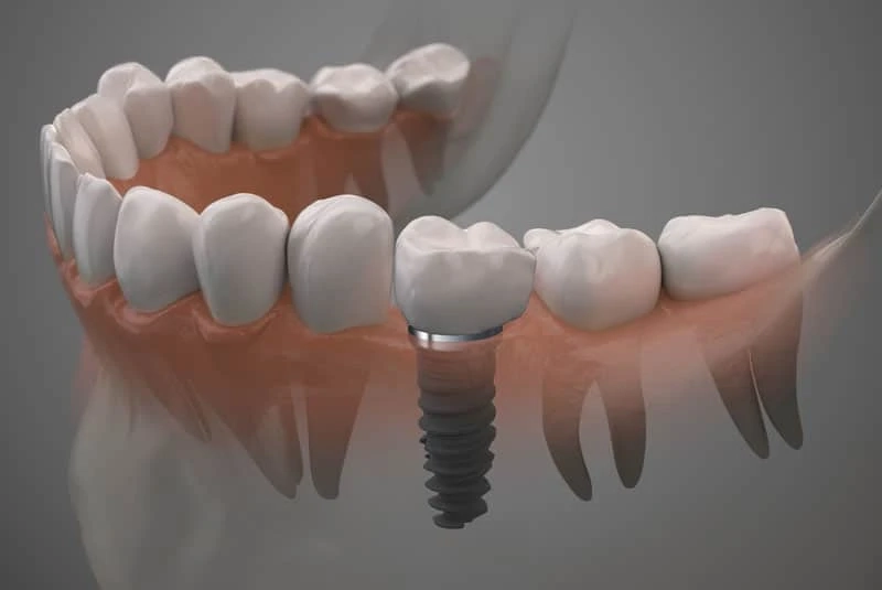 Dental Implants Explained in Baton Rouge La