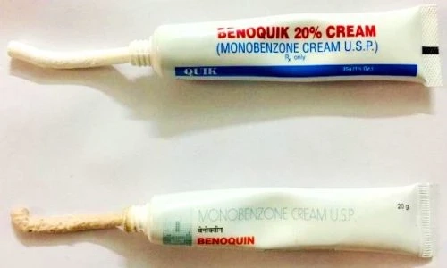 Benoquin Cream For Vitiligo Treatment