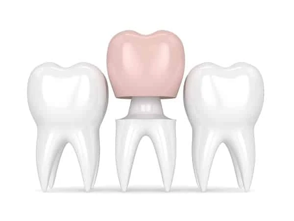 Cost of Dental Crowns and Their Types in London Ontario