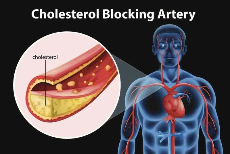 Exploring the Potential Benefits of Chelation Therapy for Atherosclerosis and Angina