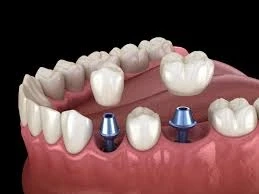 Invisalign San Diego & Implant Cost Explained – Mesa Dental, CA