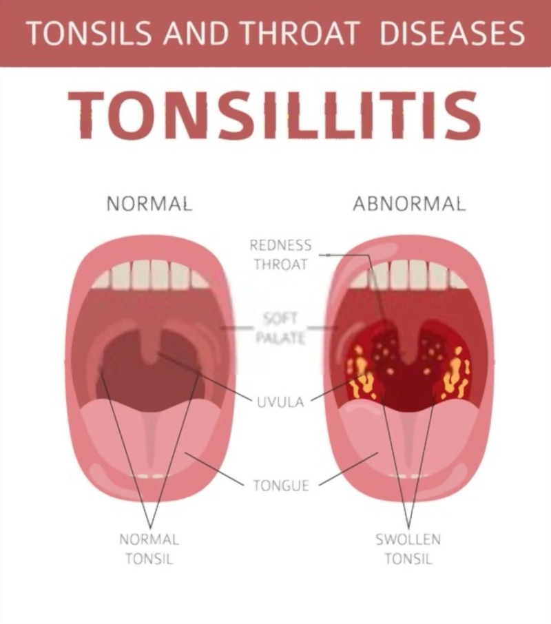 How to recover from Tonsillitis? What is Tonsillitis?
