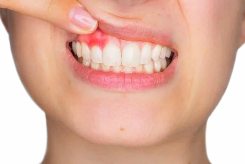 Gum Disease - Prevent Gum Disease at Home