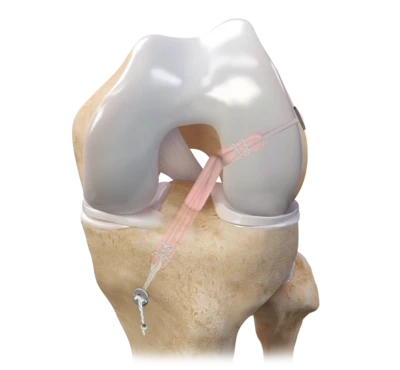 Market Analysis of Anterior Cruciate Ligament and Posterior Cruciate Ligament Reconstruction Devices