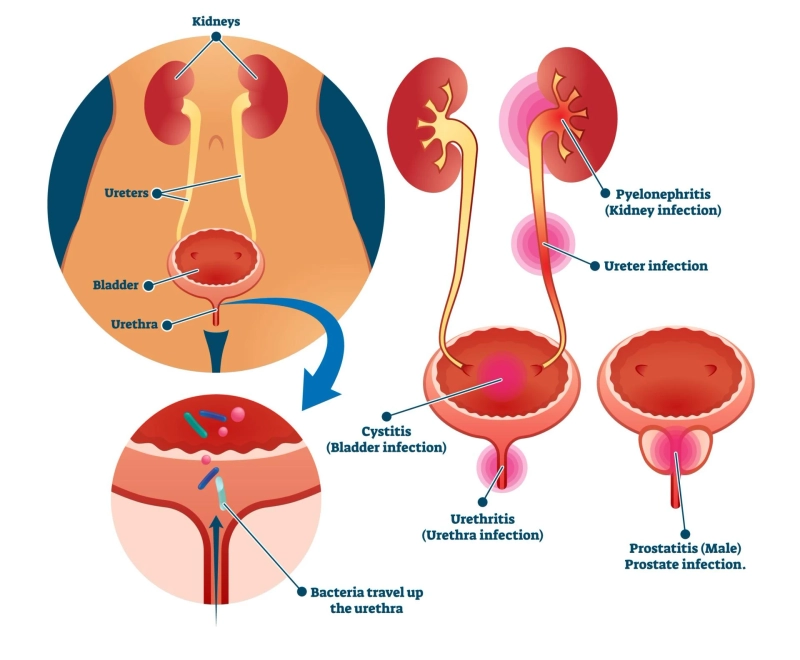 10 Common Myths About Urinary Tract Infections (UTIs) Debunked
