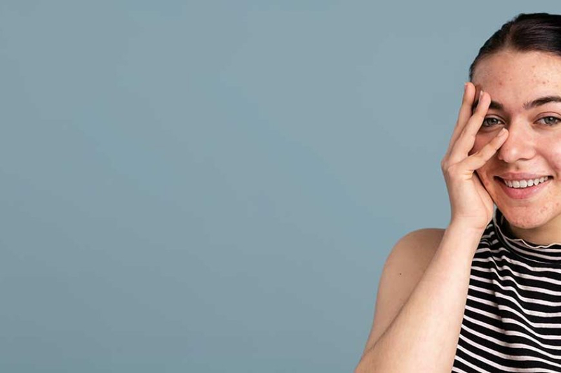 How To Treat Deep Acne Scars With Fillers?