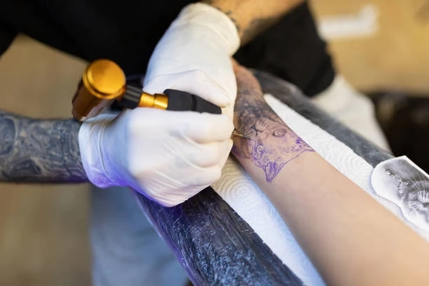 Reclaim Your Skin: Tattoo Removal Solutions in Riyadh