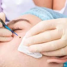 The Benefits of Early Mole Removal in Dubai