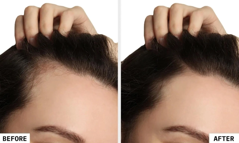 Biocell Treatment for Hair Growth: A Breakthrough Cell Therapy for Hair Loss