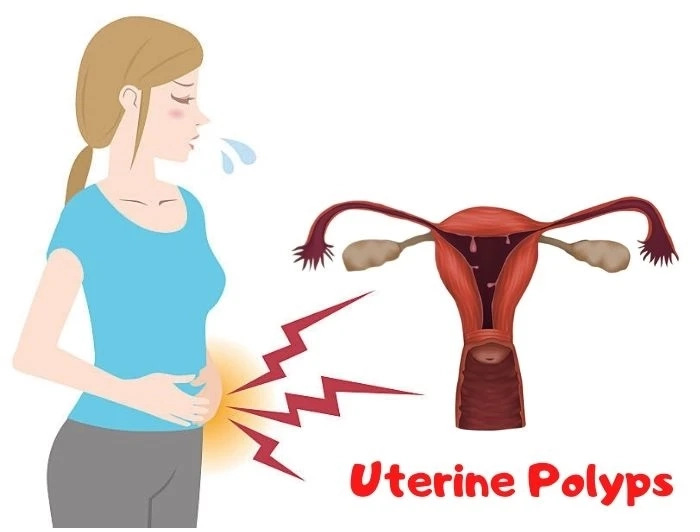 Uterine polyps: Are they an obstacle in pregnancy?