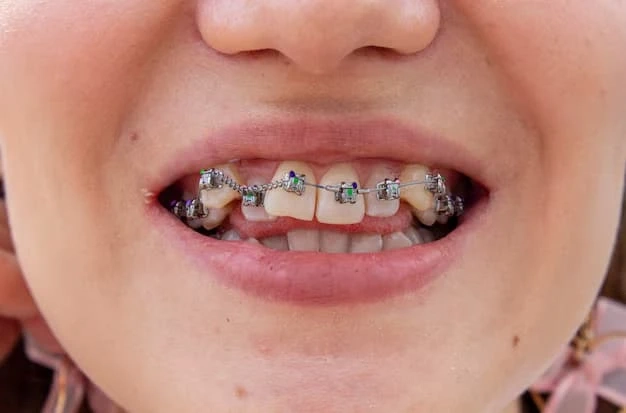 How Traditional Metal Braces Straighten Your Smile