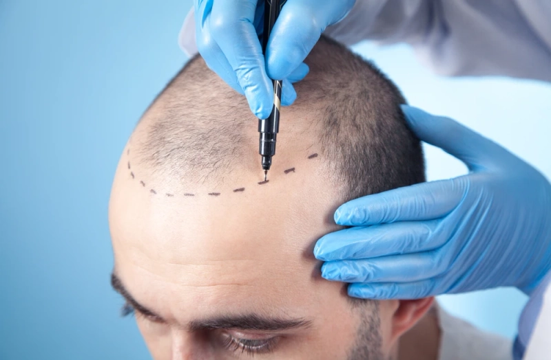 Why Skill Matters in Hair Transplant Success