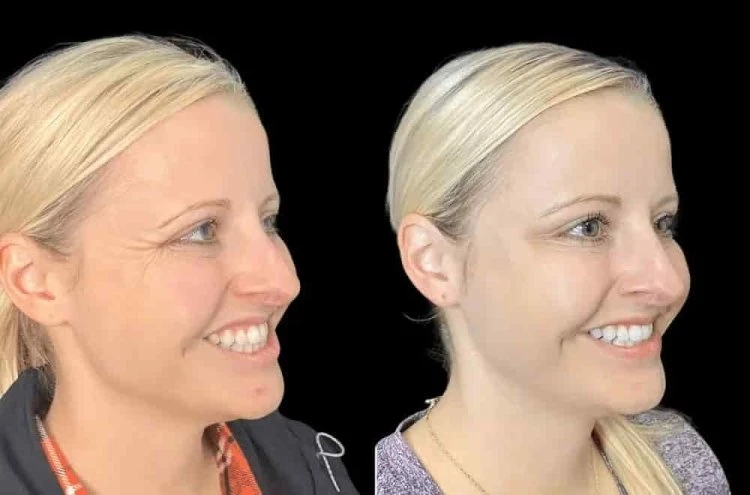 Botox Treatment in Dubai for Forehead Lines and Crow’s Feet