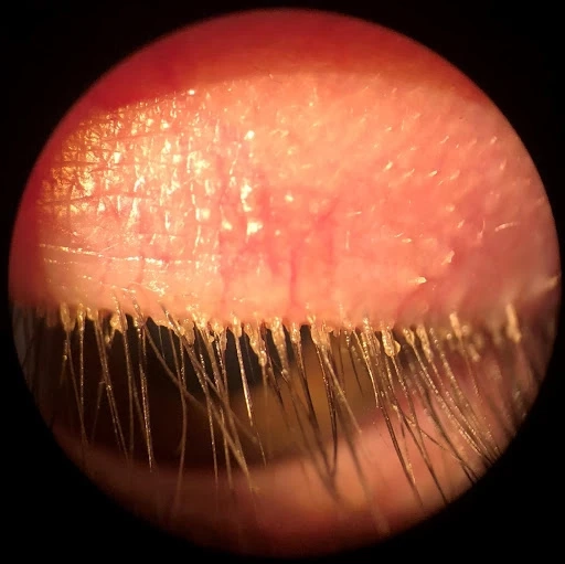 Understanding Demodex Blepharitis: Causes, Symptoms, and Treatment