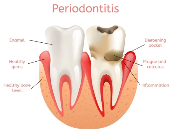 Which Tempe Periodontist Offers Advanced Gum Disease Treatment?