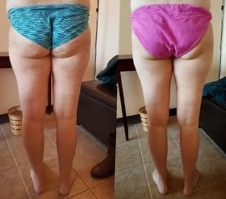 Treating Cellulite: A Comprehensive Guide to Cellulite Reduction Treatments