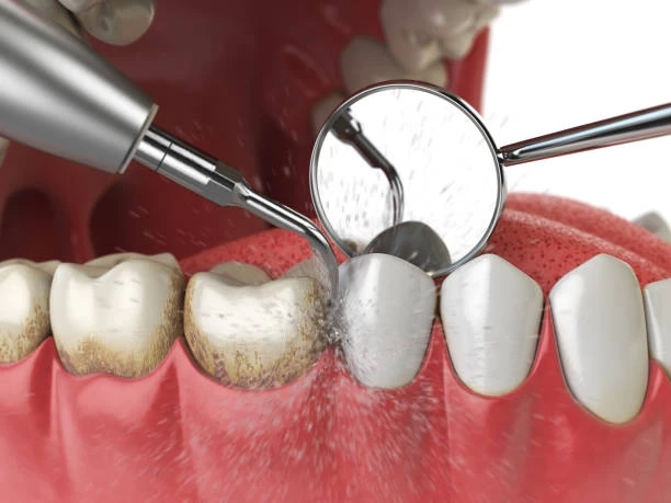 How Regular Dental Cleaning Prevents Bigger Oral Health Issues