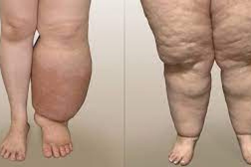 International Lipedema Surgical Center Dubai