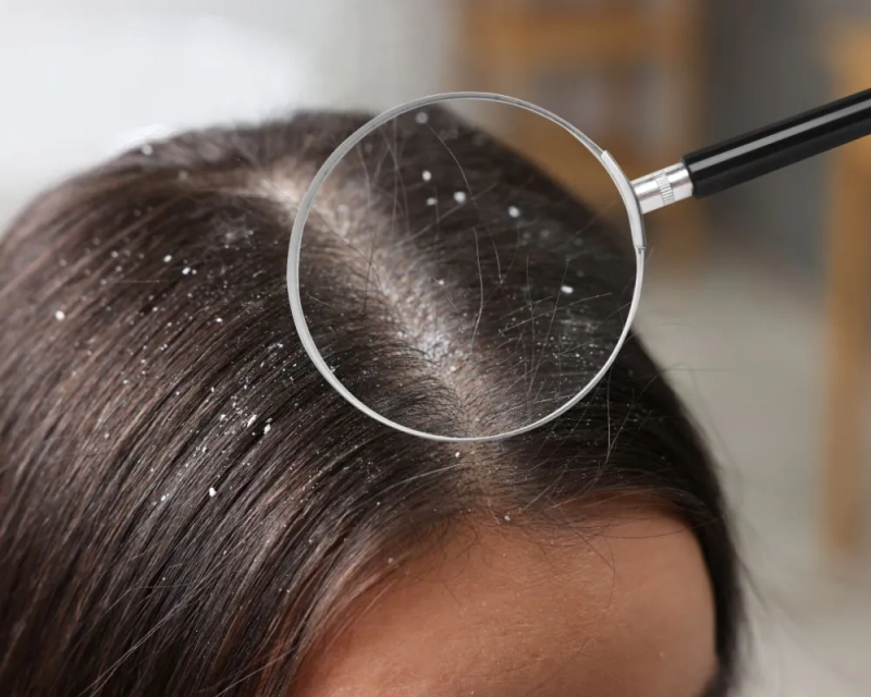 Guide to Finding the Best Dandruff Treatment in Gurgaon