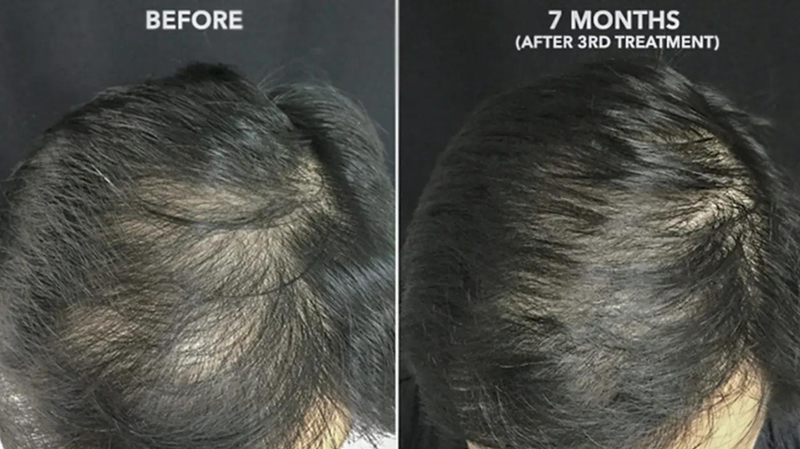 Hair Transformation: GFC Treatment Unveiled