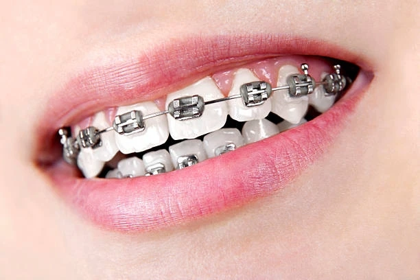 Braces New Canaan: Your Guide to a Healthier, Confident Smile