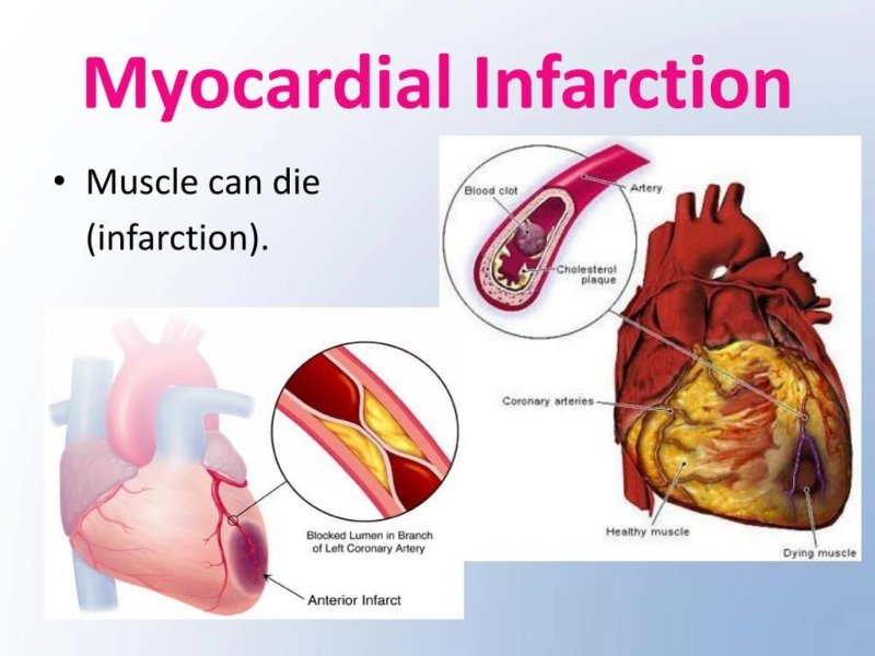 Myocardial Infarction: Early Detection and Effective Treatment