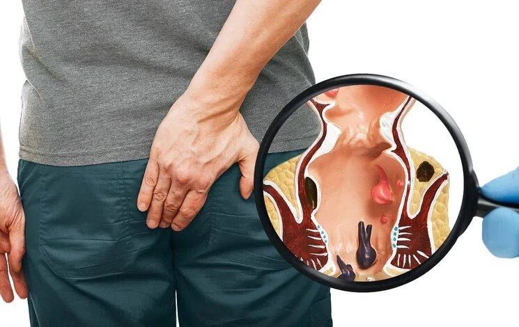 Top Piles Doctor in Mumbai: A Guide by Rai Piles Health Clinic