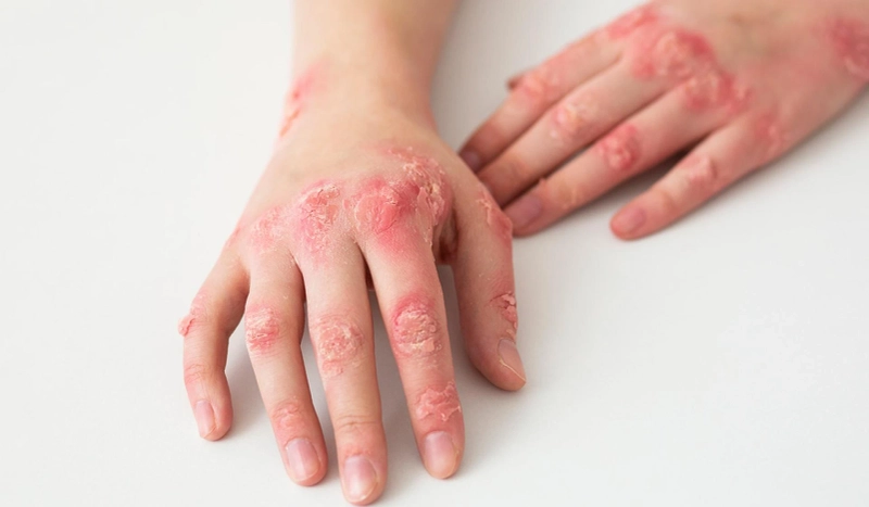 Can a Gluten-Free Diet Help Manage Psoriasis Symptoms?