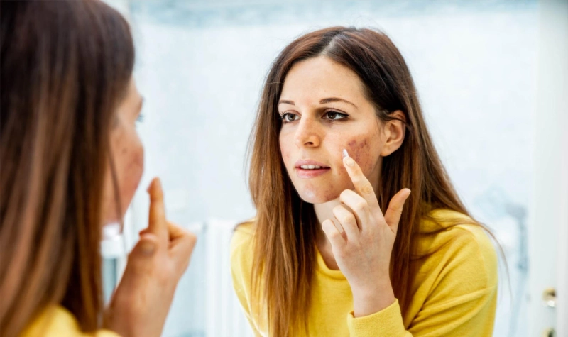 Dermatologist Recommended Treatments for Acne Scars