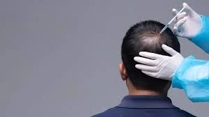 PRP for Male Pattern Baldness in Dubai: A Comprehensive Guide