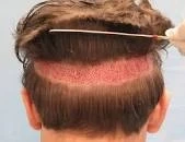 Advantages of Follicular Unit Extraction: A Comprehensive How-To