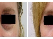 Awaken Your Beauty: Inside Eye Lid Surgery Clinics