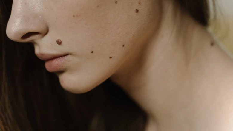 What are the best methods for skin tag removal?