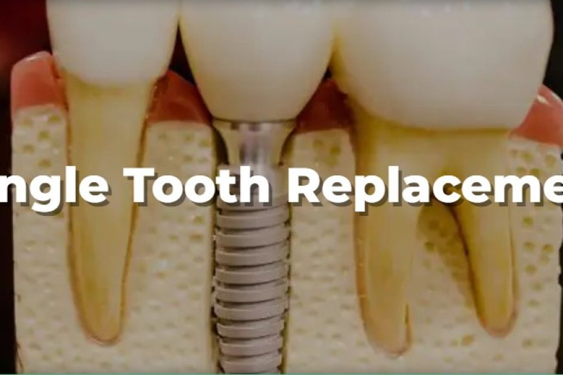 Reclaim Your Smile: Exploring Tooth Replacement Options in Houston