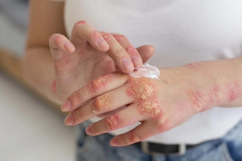 Best Ayurvedic Oils for Psoriasis: Benefits and How to Use